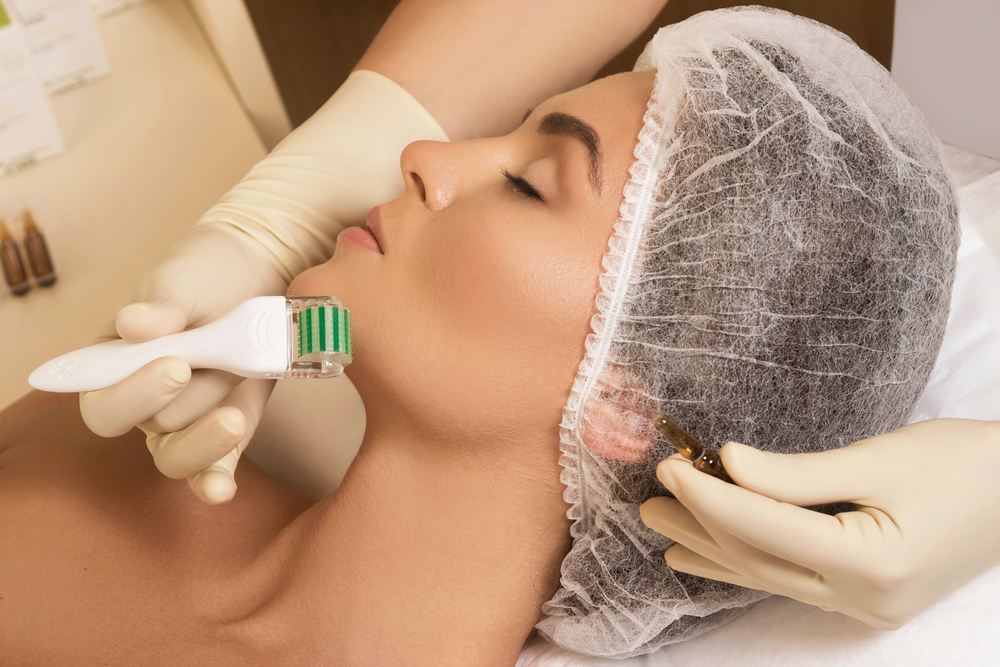 Microneedling