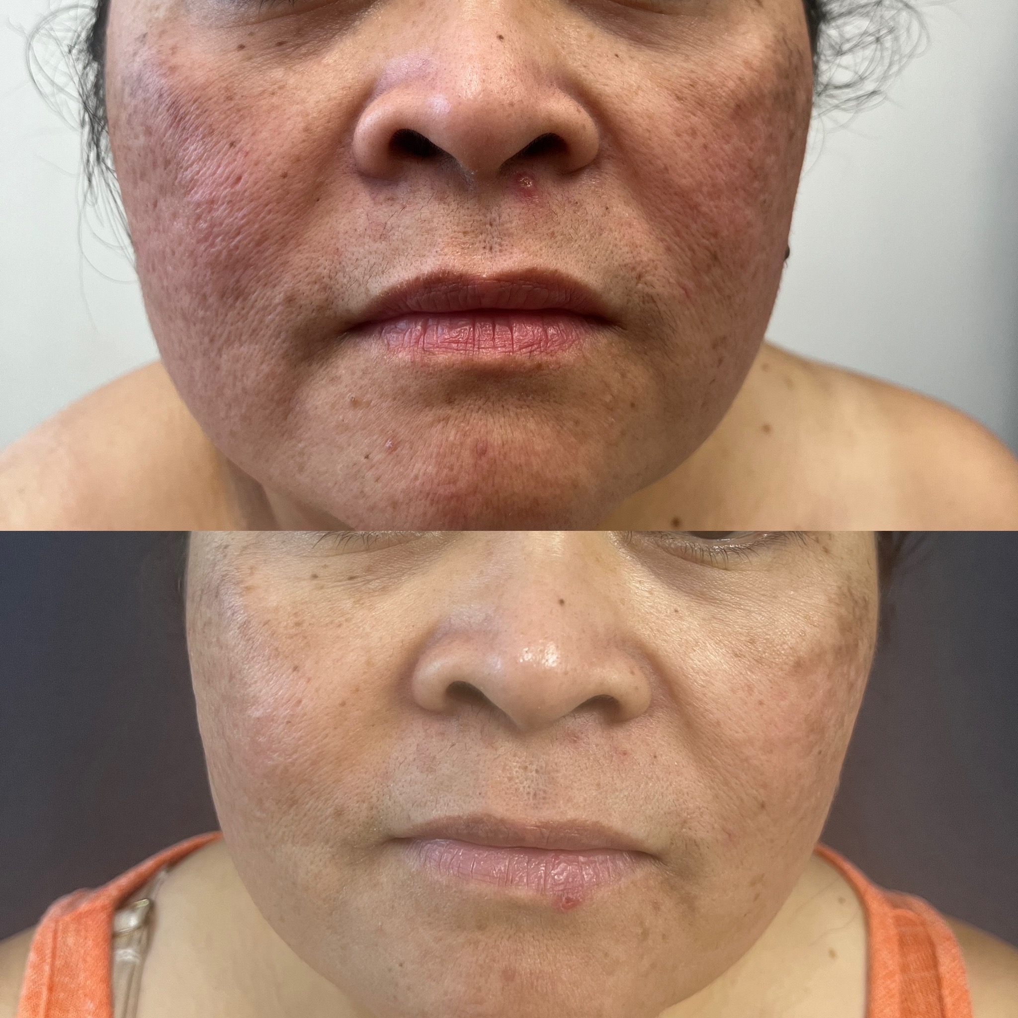 Ultra Pico Laser Nancy